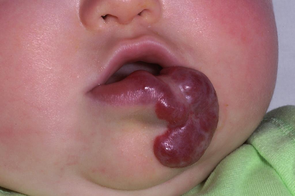 5 Before treatment After treatment Haemangiomas on the lips Haemangiomas on the lips may become ulcerated (see above right), and because ulcers are so painful, the child may not want to feed.