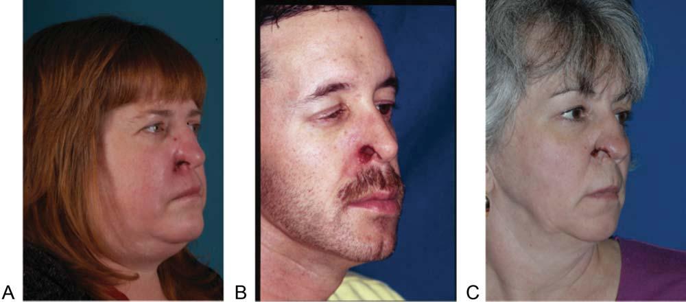 Fig. 1. Photographs from the initial clinic visits. Three-quarter views are shown for all three patients: (A) case 1; (B) case 2; (C) case 3. has been previously described.
