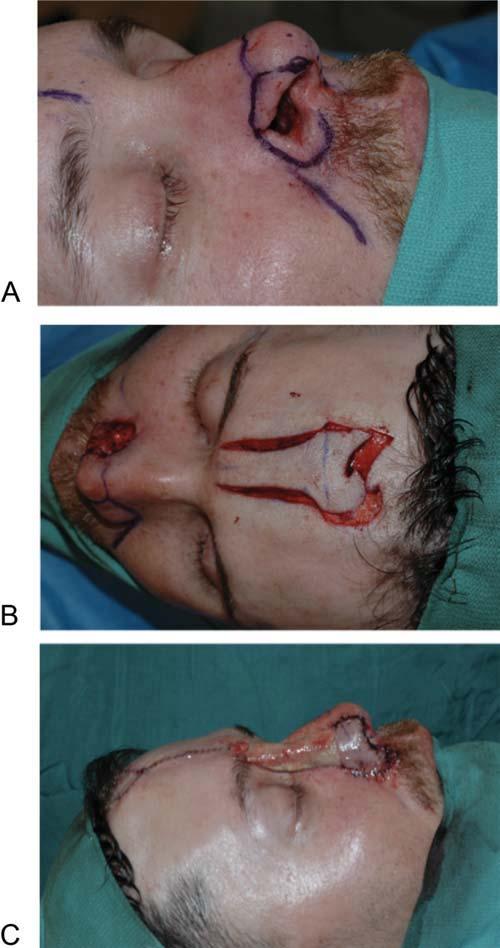Fig. 6. Intraoperative photographs from the first stage of the paramedian forehead flap reconstruction: (A) nasal alar defect; (B) design and incision of forehead flap; (C) flap sutured into position.