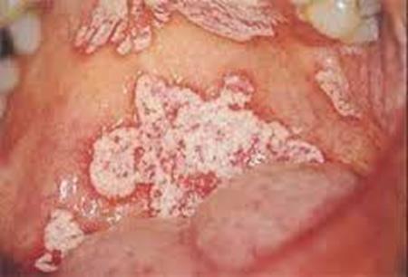 FUNGAL INFECTIONS - Candida albicans -which is part of normal flora- is the most commonly implicated organism in oral candidiasis. About (30-40%) of population carry this fungus.