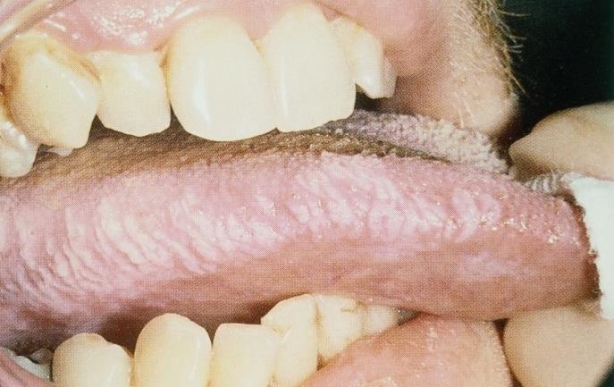 ACQUIRED IMMUNODEFICIENCY SYNDROME (AIDS) HIV infection is associated with different lesions in the oral cavity: Pseudomembranous Candidiasis Herpetic vesicles Kaposi s sarcoma: multifocal vascular