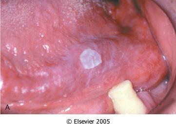 PRE-MALIGNANT LESIONS OF THE ORAL CAVITY LEUKOPLAKIA=white patch -A clinical term not a histopathological term used to describe a whitish well-defined mucosal