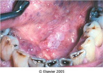 -Proliferative verrucous leukoplakia( PVL) is an uncommon form of progressive multifocal leukoplakia with a high rate of malignant transformation (very thick) ERYTHROPLAKIA =red patch -Red velvety