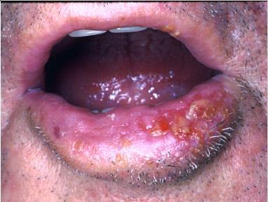 SQUAMOUS CELL CARCINOMA -most common oral cancer; represent 90% of oral cavity malignancies (3% of all malignant tumors) - most common sites: Lip > ant.