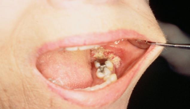 - An example of ulcer in posterior mandible in the molar area and presented with enlarged LNs of mandible and then it spreads to cervical LNs and then to