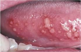 superficial ulcers, really painful, limited within few days - most common type Herpetiform aphthous ulcers =>
