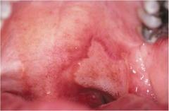 manage these ulcers but we can t cure them. If there is an underlying cause we do CBC, blood test, vit.