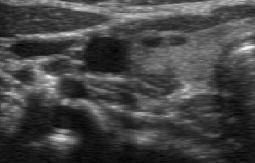 Patients information on sex, age, type of congenital hypothyroidism, and symptoms associated with nodules was studied. All patients had thyroid ultrasonography at first visit.