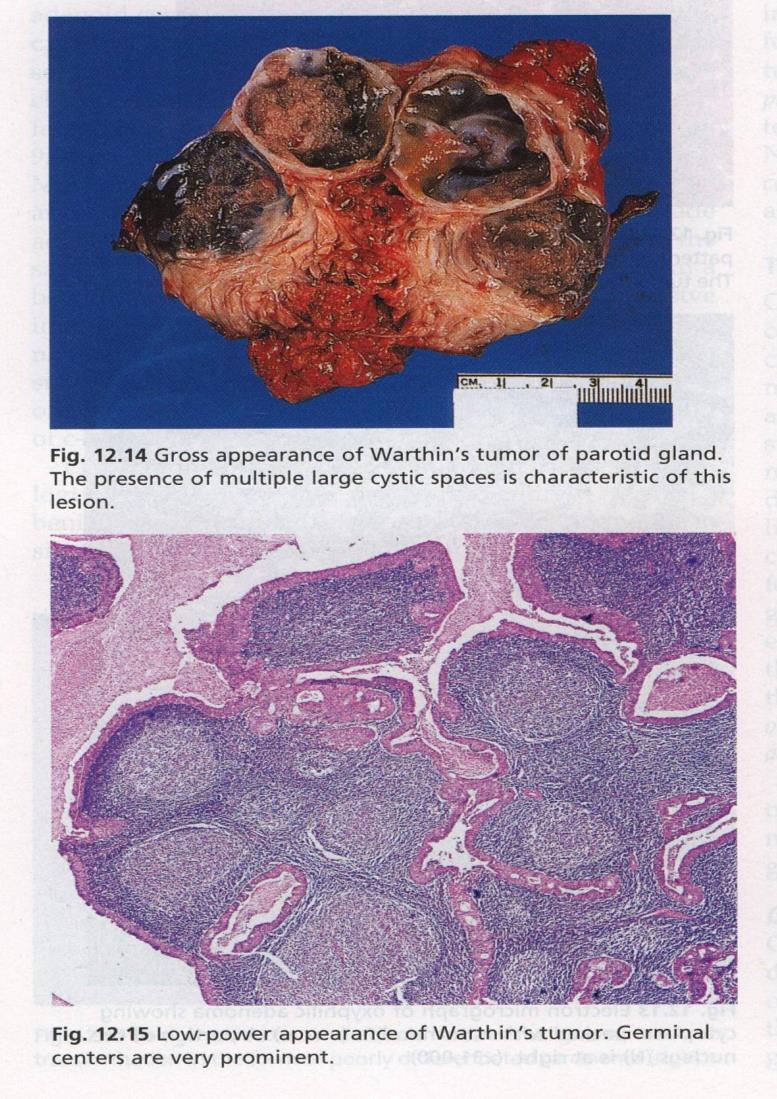 2.Papillary Cystadenoma Lymphomatosum(Warthin s Tumour) In elderly