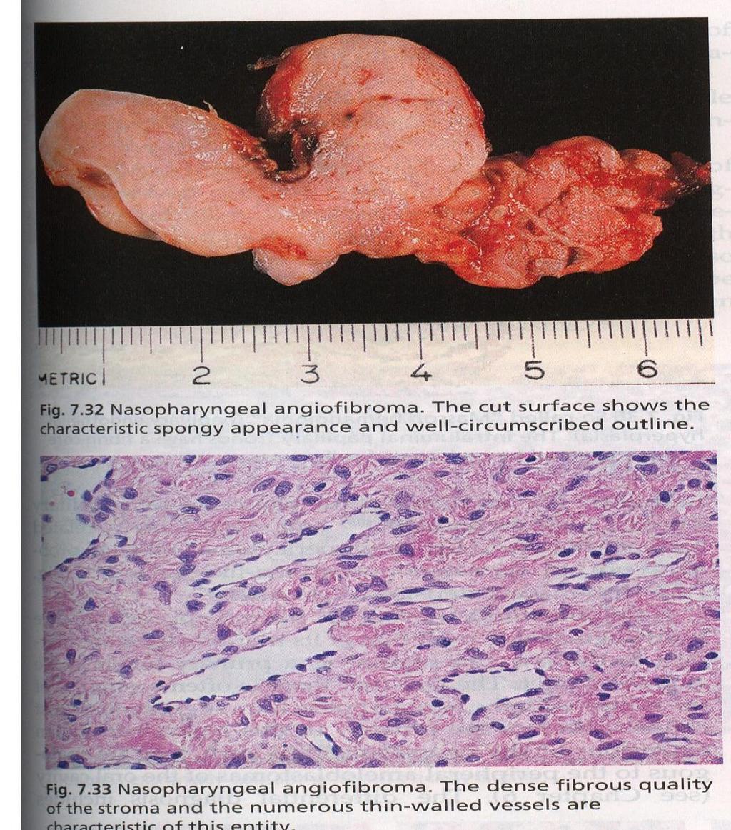 Tumours of the Pharynx Nasopharyngeal angiofibroma: Male 15-25ys