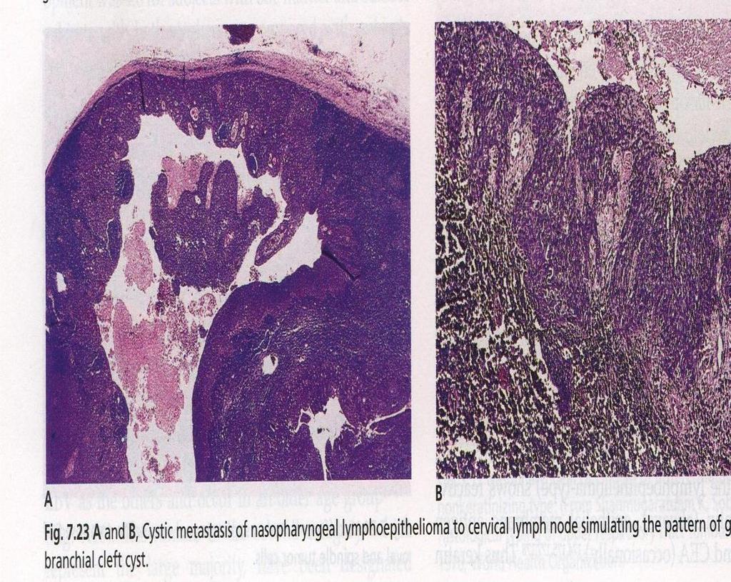 Lymphoepithelioma(Undif.Carcinoma) Adult/children male.