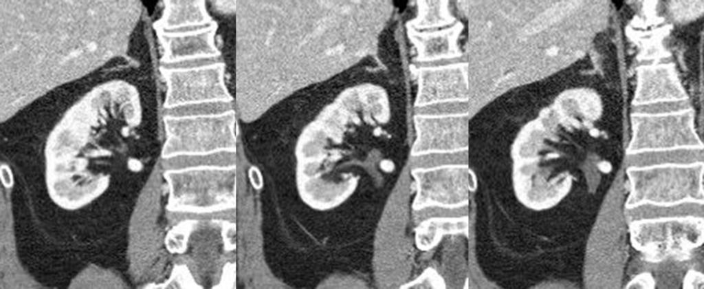 Fig. 3: Coronal CT scan show bifid ureter at Rt.