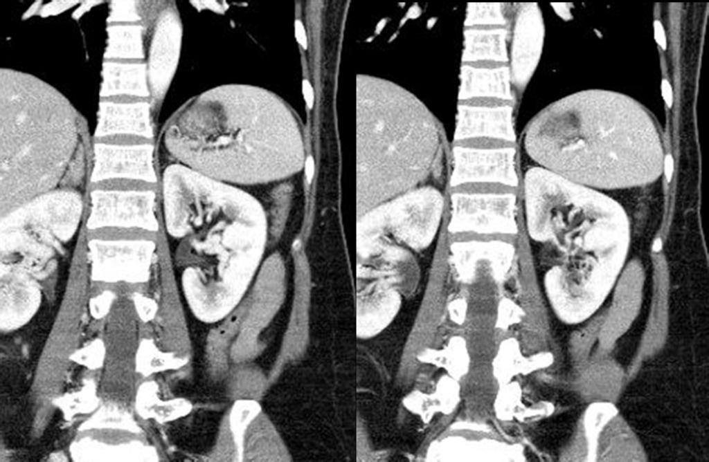 4: Coronal CT scan show bifid ureter at Lt.
