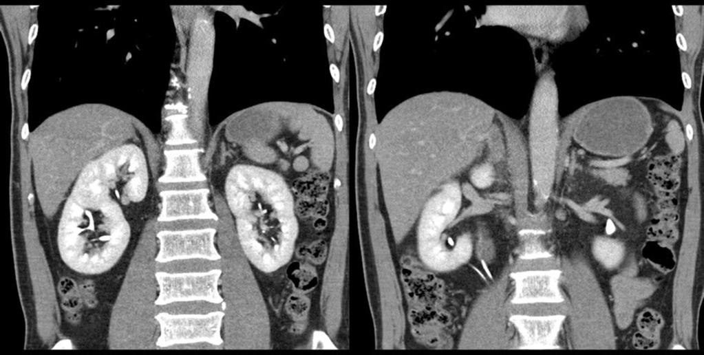 Fig. 5: Coronal CT scan show Duplication of ureter