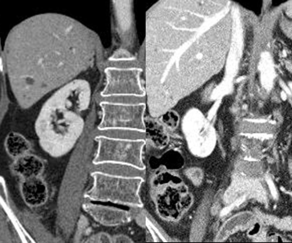 Fig. 6: Coronal CT scan show Duplication of ureter on divided