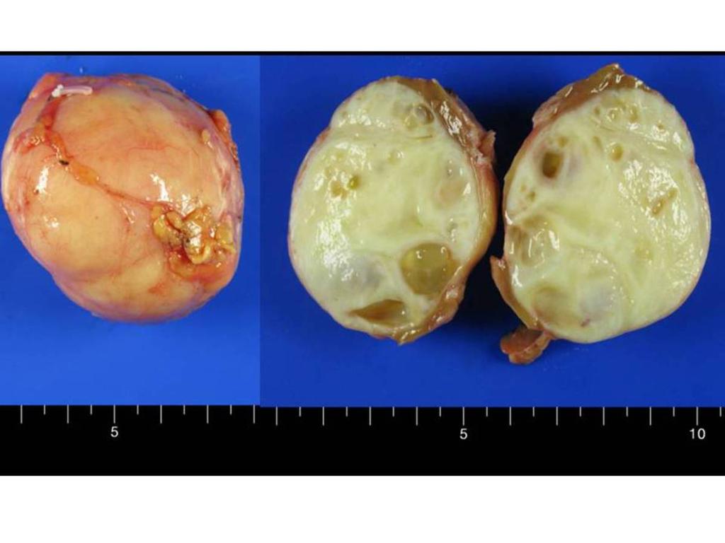 Fig. 6: Fig.6 Answer of Case 2: MEST (Mixed epithelial and stromal tumor) Rare primary renal benign neoplasm. 91 cases reported in English literatures.
