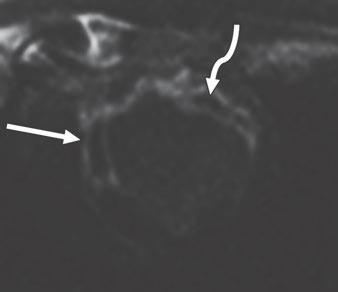 Note that no-reflow zone, indicating microvascular obstruction, involving anterior wall (curved arrows) could be mistaken for thrombus on reference standard image.