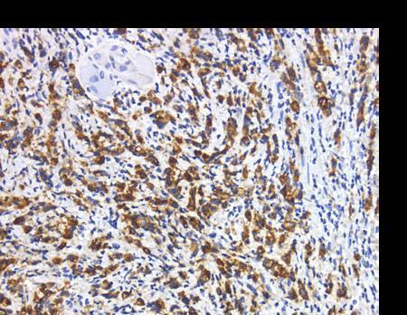 differentiated/low grade gastric adenocarcinoma N0 Tumors % Negative 19 51