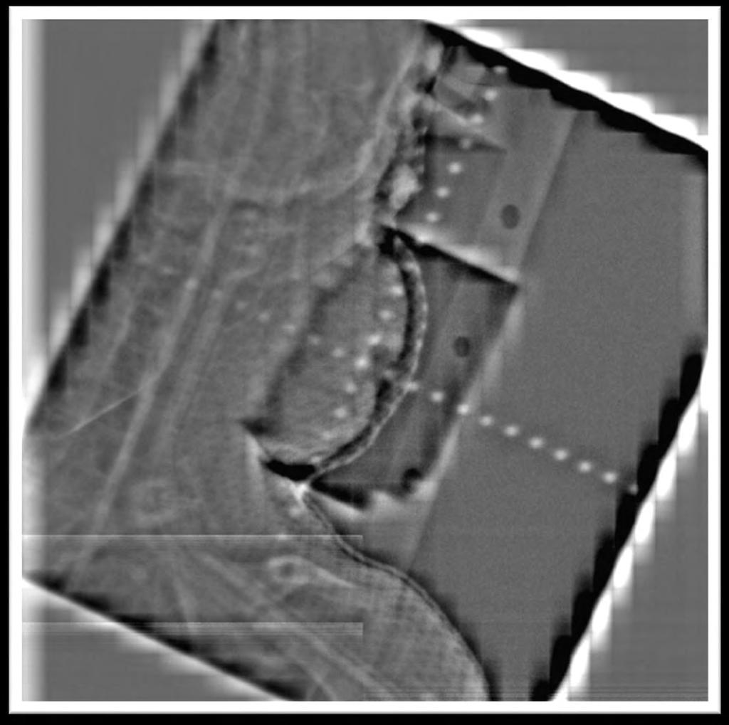 Case Examples: Case 1 EPID film taken after CBCT and shifts made to verify only tumor is