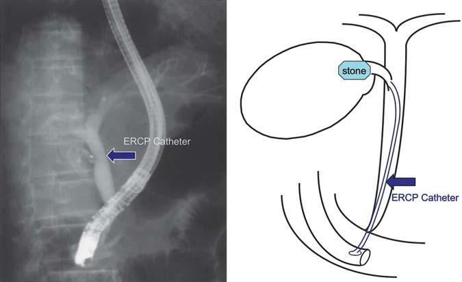B Guiding catheter: Contour (Boston Scientific). C Drainage tube (Boston Scientific).
