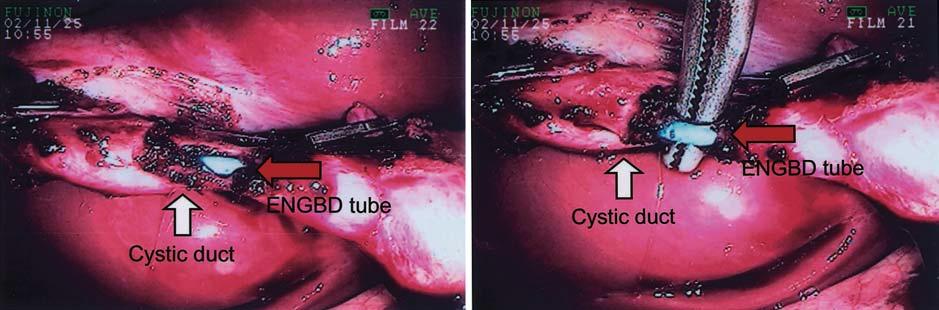 84 N. Toyota et al.: Endoscopic naso-gallbladder drainage a b Fig. 6.