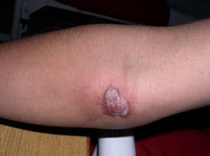 Individuals at high risk of cutaneous leishmaniasis include military personnel and those who travel to or live in areas of the tropics, subtropics and southern Europe where the disease is endemic