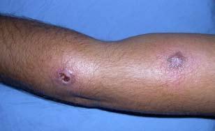 5 ml (42.5 mg of meglumine antimoniate) into each lesion, upper and mid-dermis daily; and group 3 consisting of patients unwilling to receive treatment, thus serving as a control group.