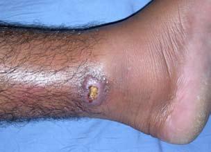 Figure 10. An ulcerated plaque with yellowish base on the left lower leg. Adverse effects commonly reported were mylagias, arthralgias, headache, urticaria, cellulitis and pain at injection sites.