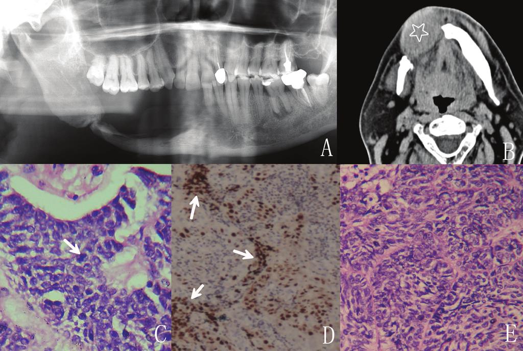 Med Oral Patol Oral Cir Bucal. 2015 May 1;20 (3):e365-71. Fig. 1. Radiographic, histological and immunohistochemical findings in Case 1.