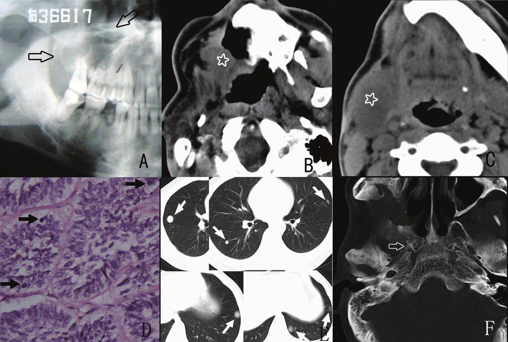 Med Oral Patol Oral Cir Bucal. 2015 May 1;20 (3):e365-71. Fig. 2. Radiographic and histological findings in Case 4.