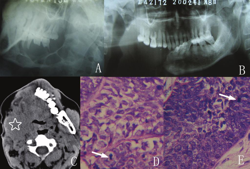 Med Oral Patol Oral Cir Bucal. 2015 May 1;20 (3):e365-71. Fig. 3. Radiographic and histological findings in Case 4.