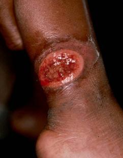 edu/ Leishmaniasis is a parasitic disease classified as Neglected Diseases