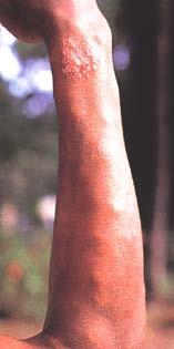 Mucocutaneous Leishmaniasis Occurs In Central and South America only