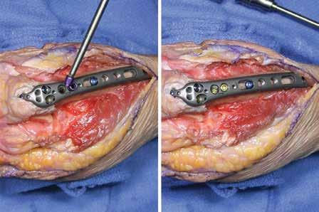NOTE: If the HR Tab has been repositioned, consider the use of a Polyaxial Locking Screw if impingement occurs.