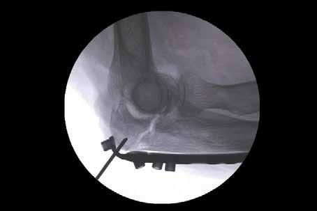 FRACTURE REDUCTION 9 Reduce the fracture by levering the shaft of the plate to the distal fragment. Confirm fracture reduction and plate alignment using fluoroscopy.
