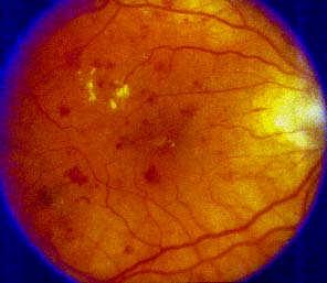 Red Spots: Diabetic Retinopathy Red Spots: Diabetic Retinopathy Diabetic retinopathy Epidemic of preventable blindness Leading cause of