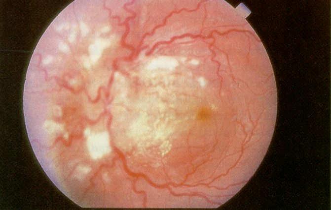 Retinopathy Hypertensive retinopathy Fundus findings similar to diabetic retinopathy Not a major cause of vision loss by itself When severe, the