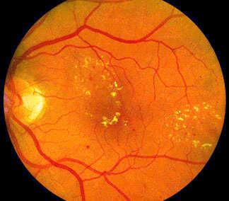 Diabetic Retinopathy Non-Proliferative Diabetic Retinopathy An epidemic of preventable blindness At least 90% preventable with proper screening and