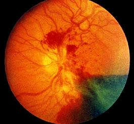 permanent vision loss has occurred Non-Proliferative DR Proliferative Diabetic Retinopathy Microaneurysms (the source of edema) Dot, blot and flame
