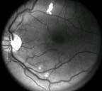 Retinal vein occlusions BRVO localized area of hemorrhages CRVO hemorrhages throughout fundus Treatment