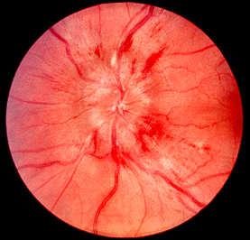 Immediately Swollen optic discs Papilledema Optic Neuritis Temporal (giant cell) arteritis Buried drusen