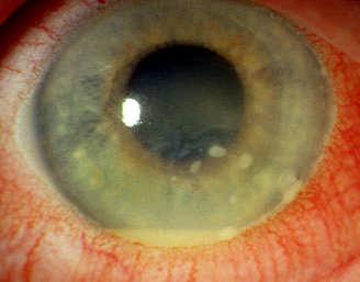 pain and photophobia Physical findings may be subtle, especially without a slit lamp Ciliary flush may be