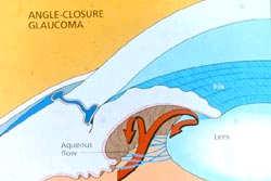 Angle-Closure Glaucoma Pain without Discharge Angle-closure glaucoma: a true