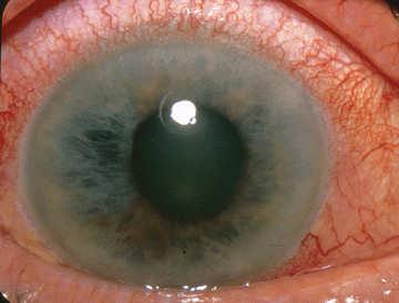 mid-dilated pupil Steamy cornea Nausea and vomiting Angle-Closure Glaucoma