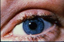 body sensation Eyelid swelling Pain without