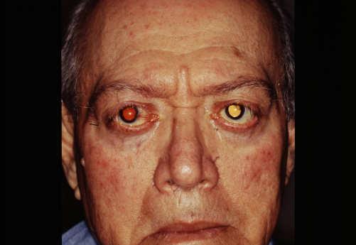 Itching and Burning Allergic Conjunctivitis