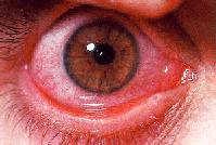 Primary Symptom: Discharge Viral conjunctivitis: Watery discharge (may be thicker in a.m.) Bacterial conjunctivitis: Purulent discharge Allergic conjunctivitis: Mucoid discharge Viral Conjunctivitis