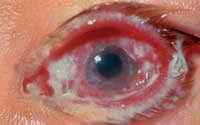 adenovirus, many others Treatment: Viral conjunctivitis: Tx Handwashing to prevent spread Artificial tears Sunglasses when outside Cool compresses Refer if worsening, vision blurred, or if not