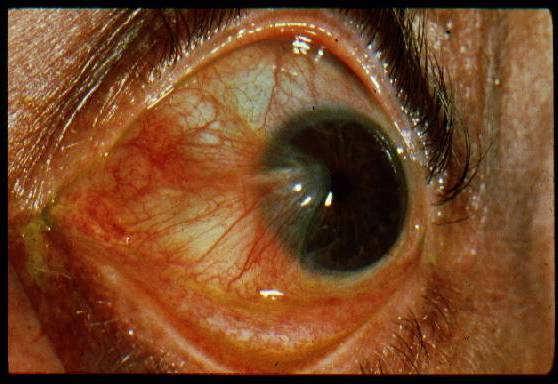 medial or lateral to limbus Pterygium: abnormal conjunctiva loses contact inhibition, partially covers cornea Treatment: