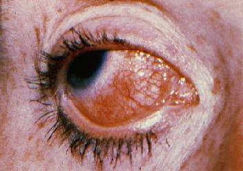 Episcleritis Episceritis Painless dilation of episcleral vessels, usually in one sector of one eye Usually benign and self-limited Occasionally associated w/rheum disease Treatment: refer to oph for